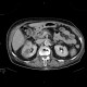 Pyelonephritis, kidney: CT - Computed tomography